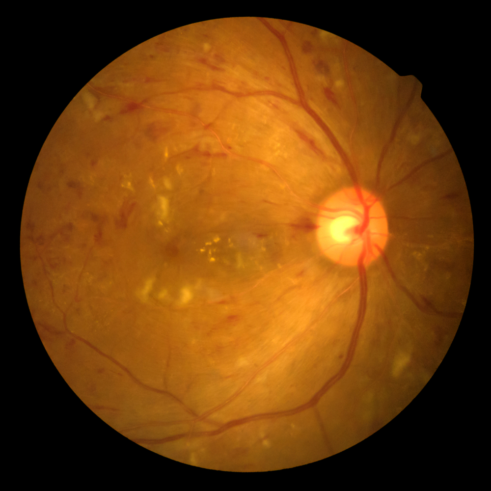 האבחנה של רטינופתיה סוכרתית (עין סוכרתית) מתבצעת בבדיקה של רופא העיניים לאחר הרחבת אישונים. במידה ויעלה חשד למחלה מתקדמת או לבצקת מקולרית יבוצעו בדיקות הדמייה נוספות כגון OCT המאפשר למדוד את עובי המקולה או פלורוסצאין אנגיוגרפיה.