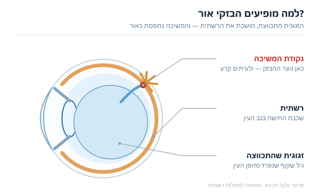 איור חתך של העין — הזגוגית מתכווצת ומושכת את הרשתית בנקודת ההיצמדות, והמשיכה נתפסת כהבזק אור