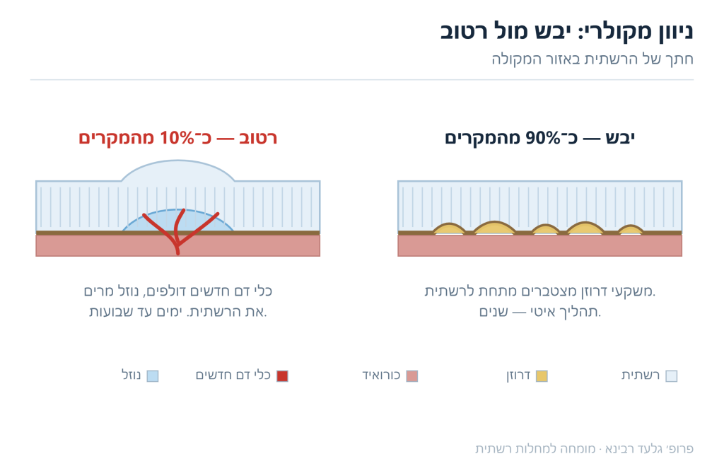 איור חתך של הרשתית — בצורה היבשה מצטברים משקעי דרוזן, ובצורה הרטובה צומחים כלי דם חדשים שדולפים נוזל ומרימים את הרשתית