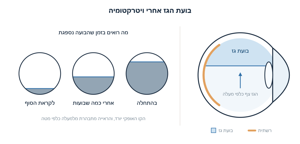 איור: בועת גז ממלאת את החלק העליון של חלל העין ולוחצת על הרשתית, ולצידה שלושה שלבים של שדה הראייה שבהם הקו האופקי יורד ככל שהגז נספג