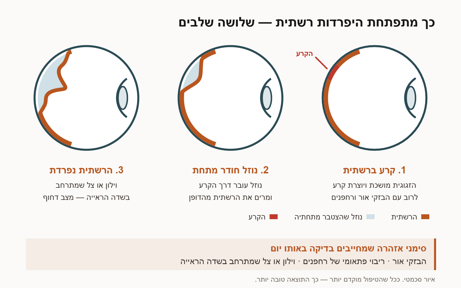 איור סכמטי של שלושת שלבי היפרדות הרשתית: קרע, נוזל שחודר מתחת לרשתית, והיפרדות שמתפשטת