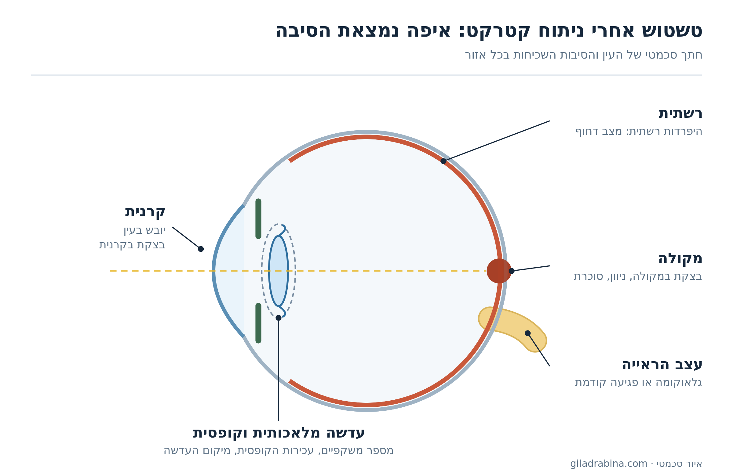 איור סכמטי של חתך העין והסיבות השכיחות לטשטוש אחרי ניתוח קטרקט: קרנית, עדשה מלאכותית וקופסית, מקולה, רשתית ועצב הראייה
