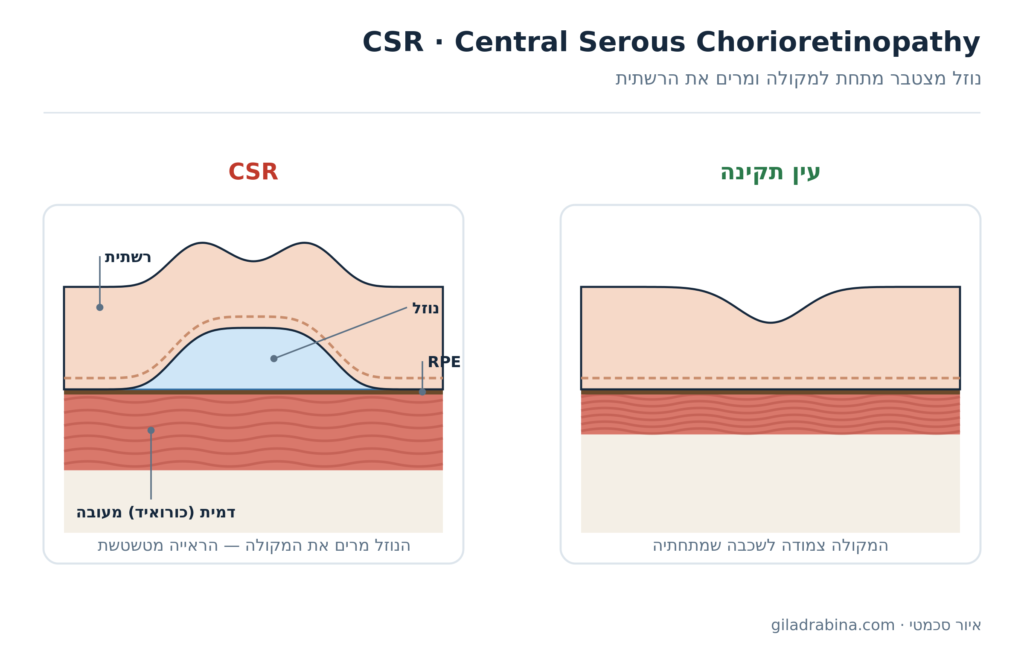 איור סכמטי: עין תקינה לעומת CSR, נוזל מתחת למקולה מרים את הרשתית מעל דמית מעובה