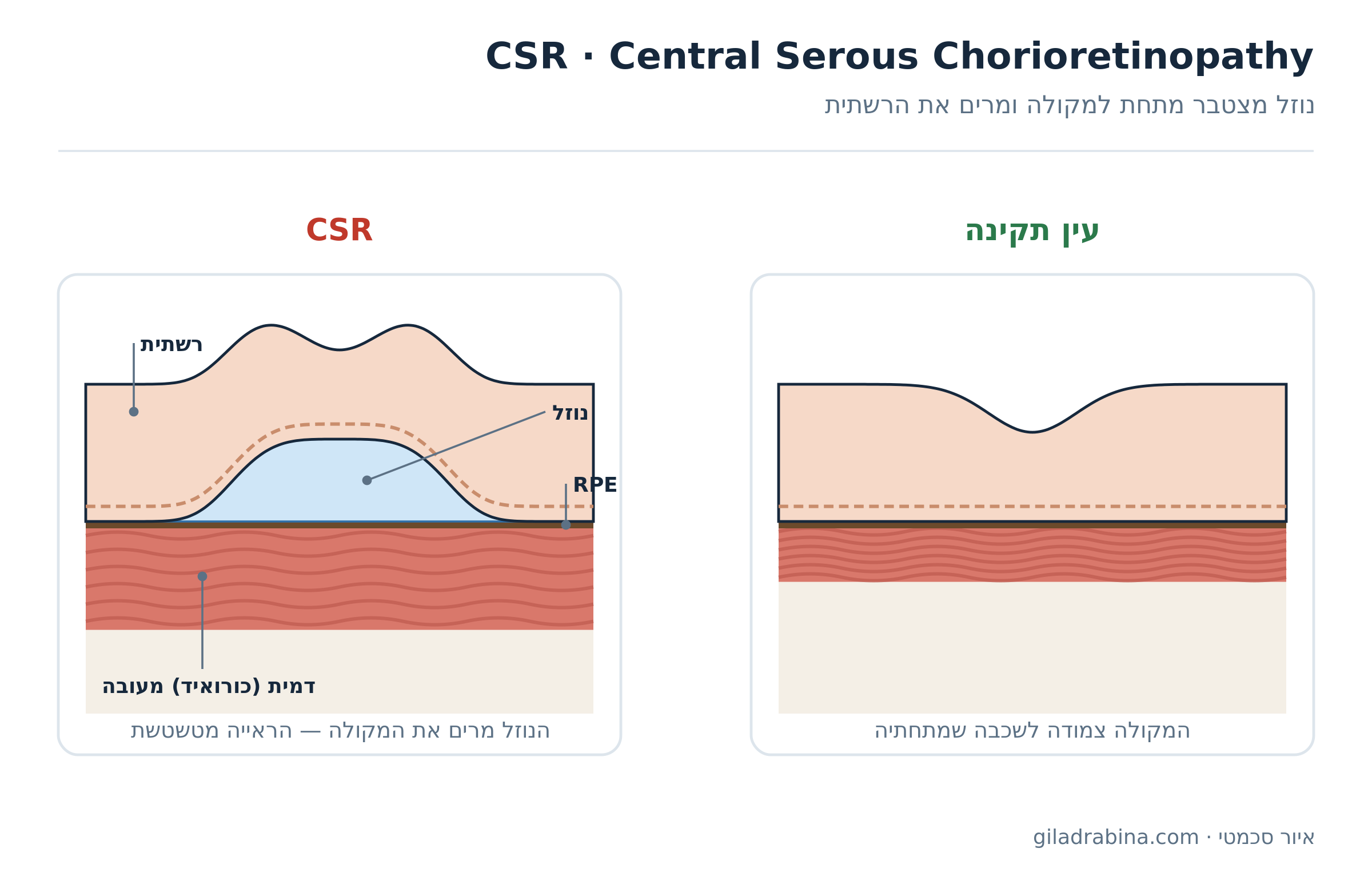 איור סכמטי: עין תקינה לעומת CSR, נוזל מתחת למקולה מרים את הרשתית מעל דמית מעובה