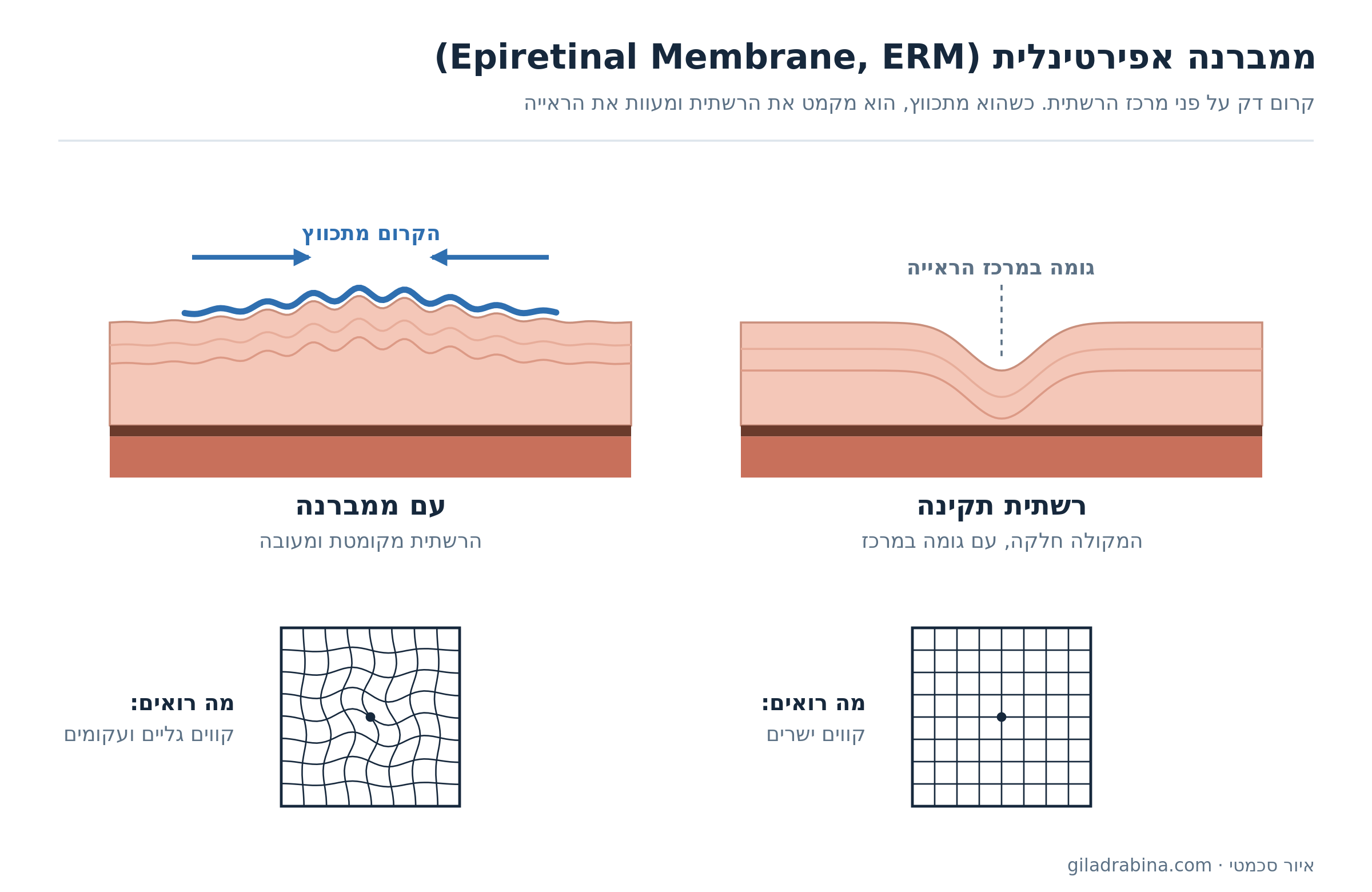 איור: רשתית תקינה לעומת רשתית עם ממברנה אפירטינלית (ERM), ומה המטופל רואה – קווים ישרים לעומת קווים גליים