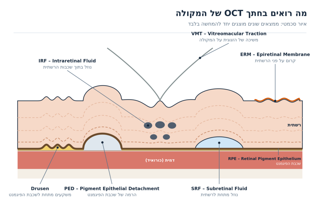 איור סכמטי של חתך OCT במקולה: נוזל תוך-רשתי (IRF), נוזל תת-רשתי (SRF), הרמת שכבת הפיגמנט (PED), דרוזן, ממברנה אפירטינלית (ERM) ומשיכה של הזגוגית (VMT)